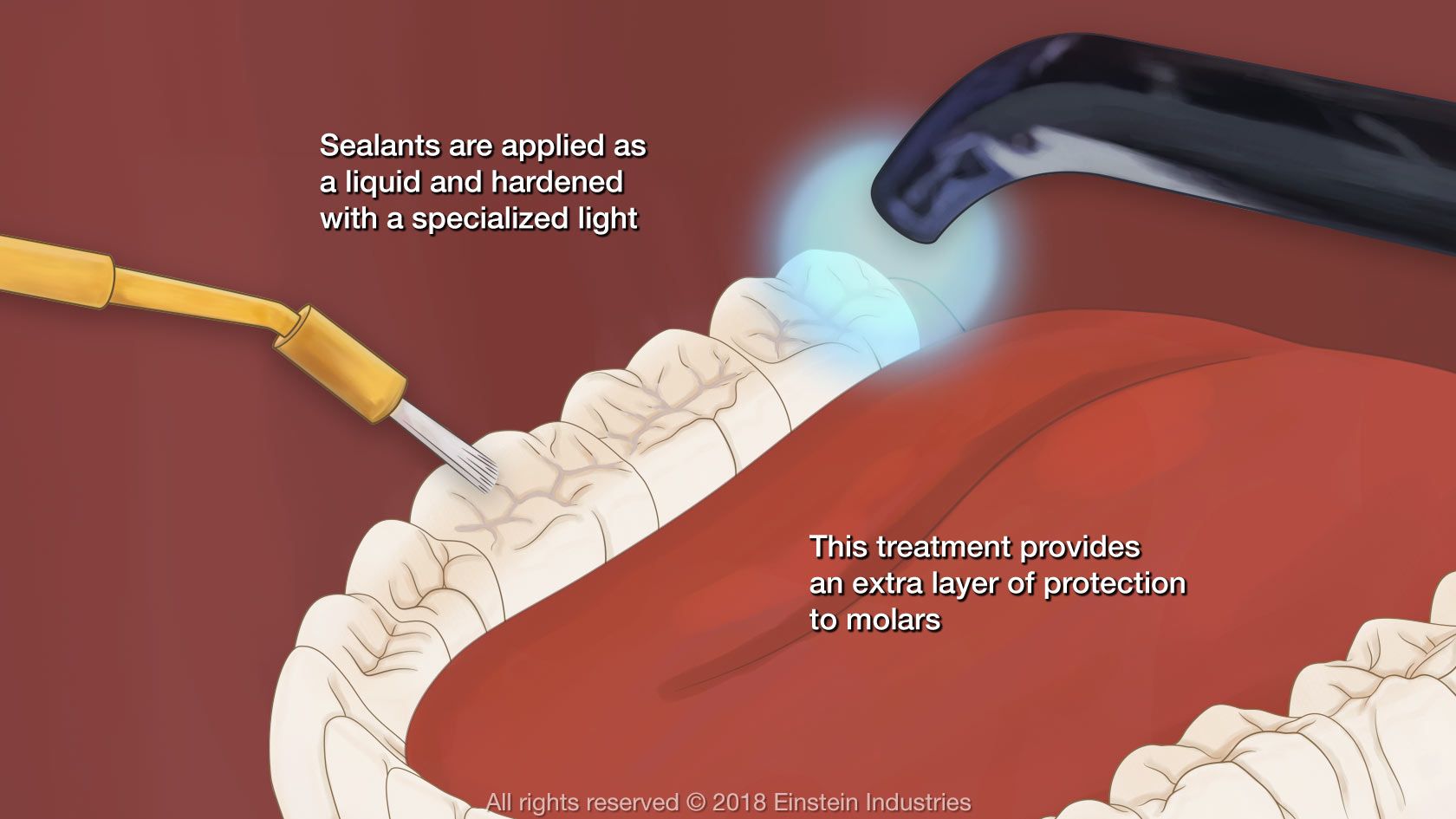 dental sealants