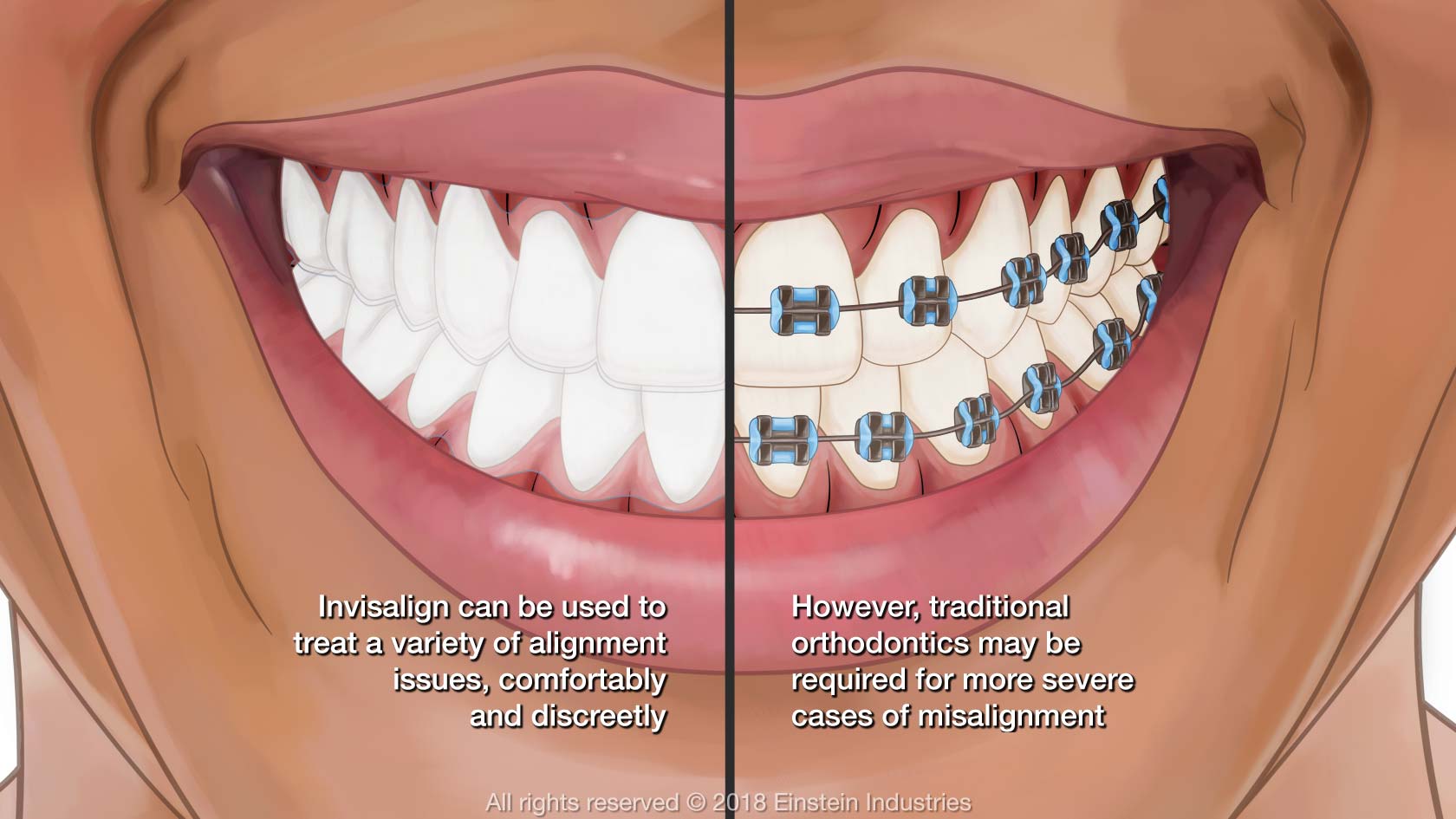 Adult Orthodontics in Chicago, IL