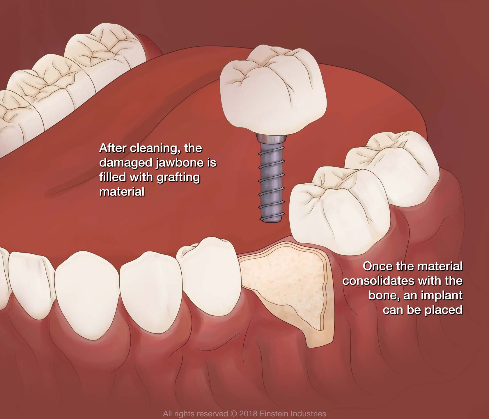 bone grafting