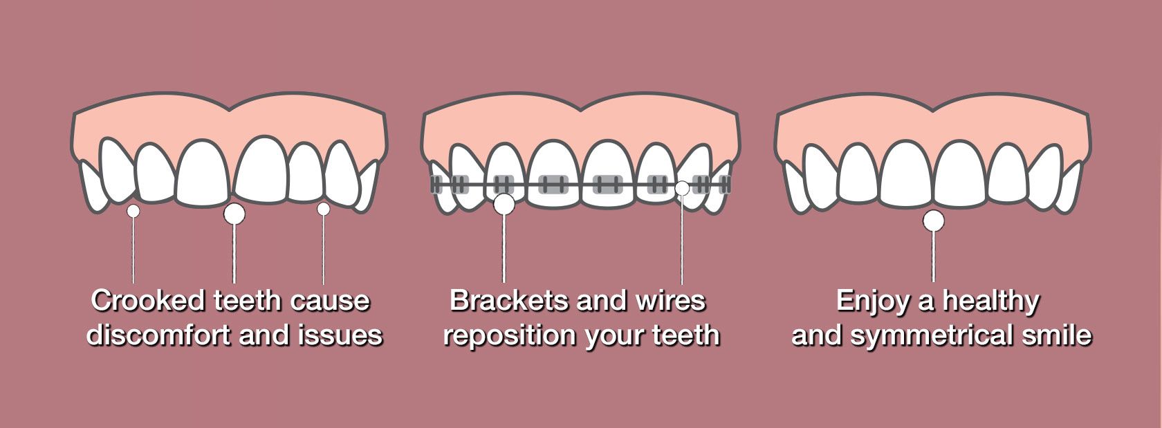 braces