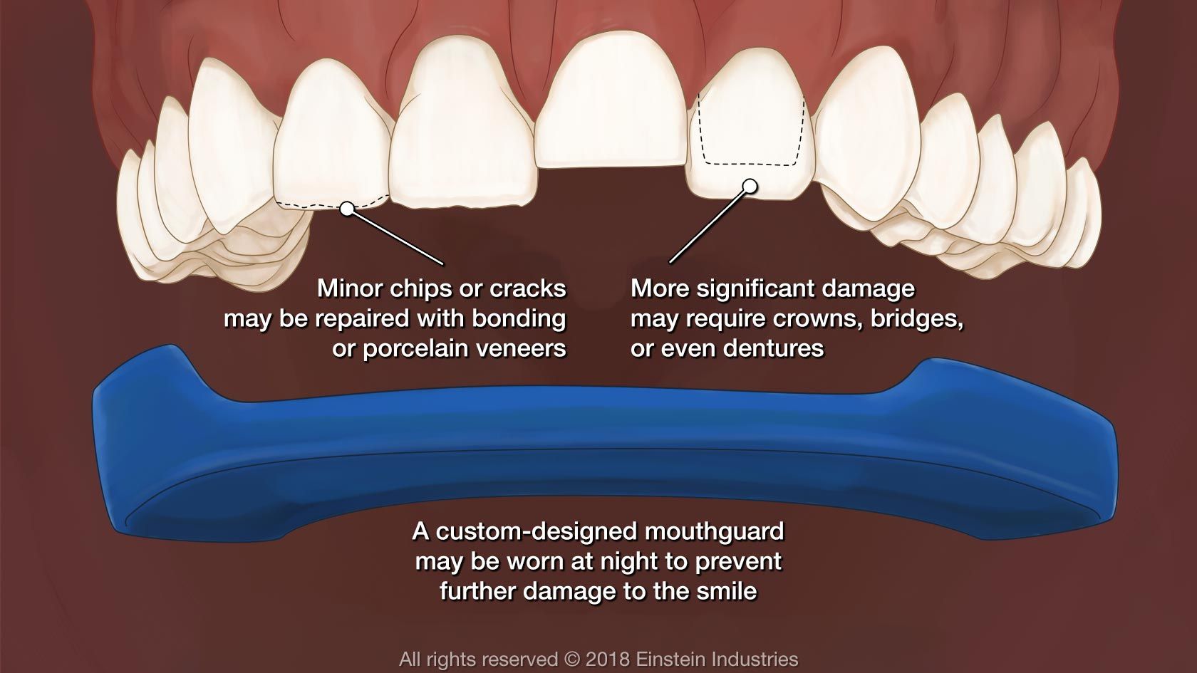 teeth grinding