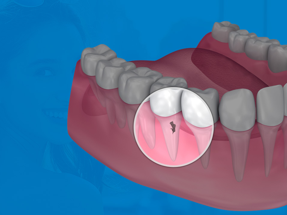 crown lengthening