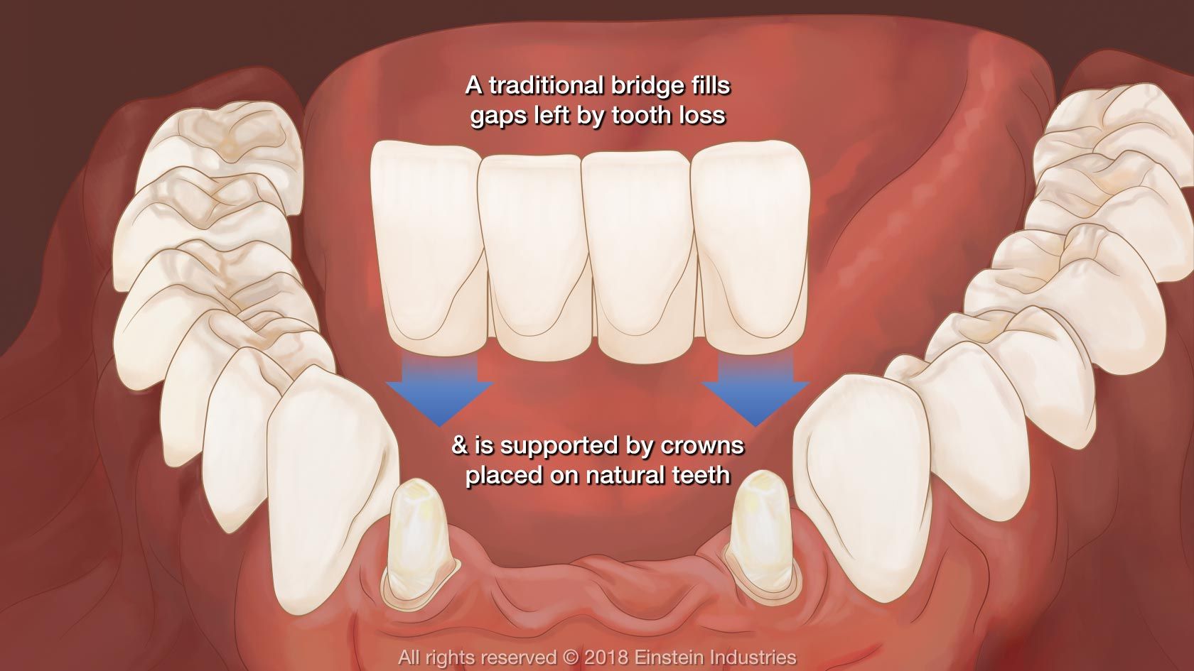 dental bridges