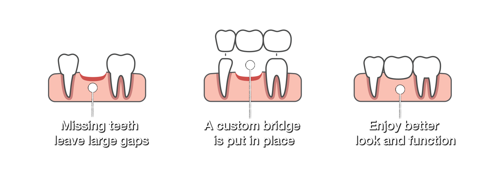 dental bridges