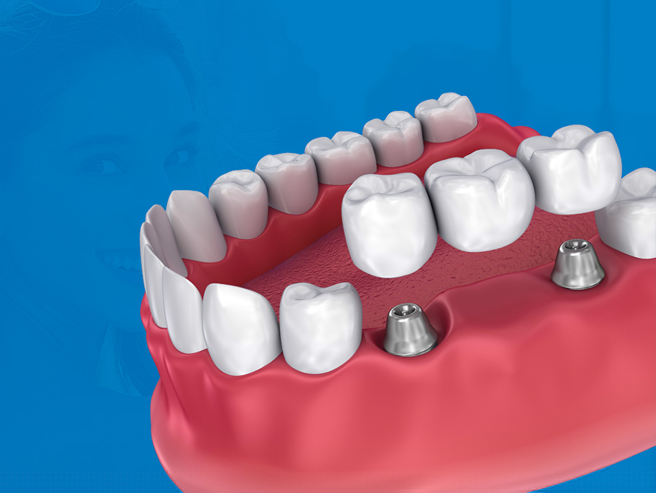 dental bridge