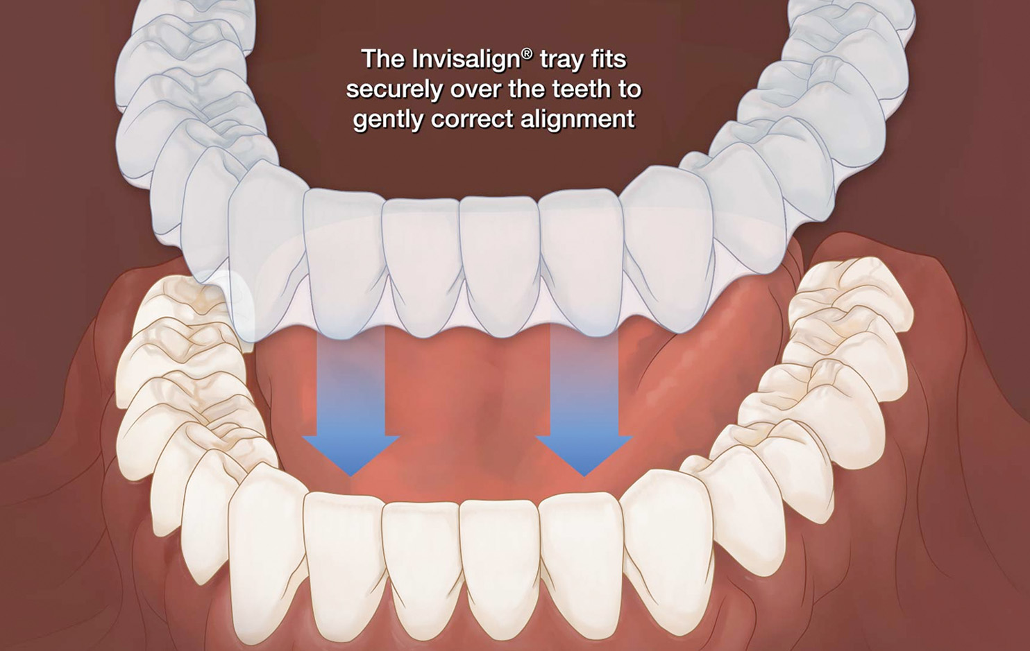 Invisalign