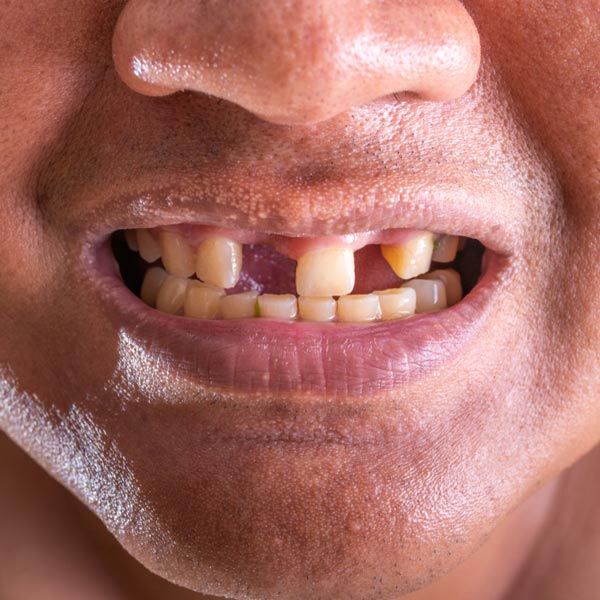 Multiple Areas of Tooth Loss