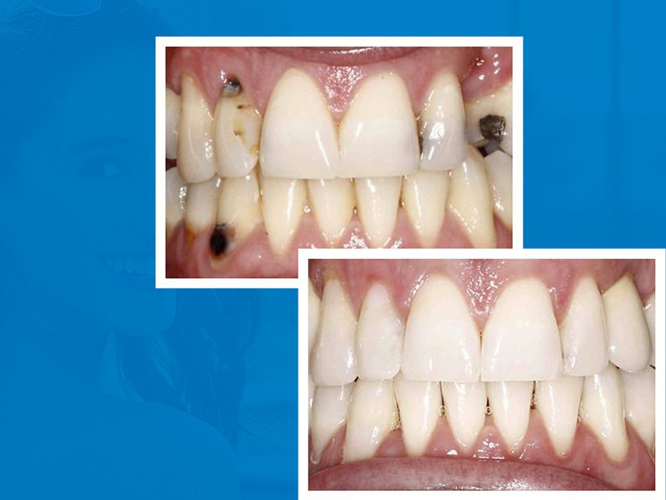 full mouth reconstruction