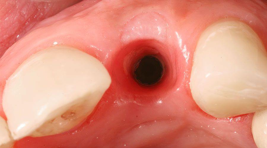 bone-graft-for-dental-implants-2