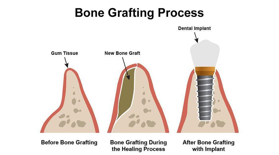 bone-graft-for-dental-implants