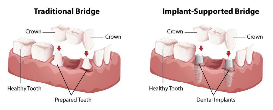 bridges-types-2