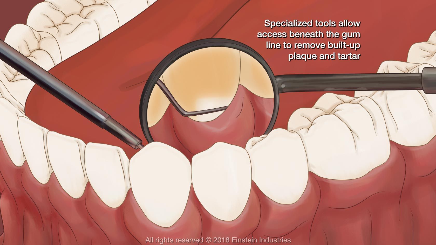 dental cleaning