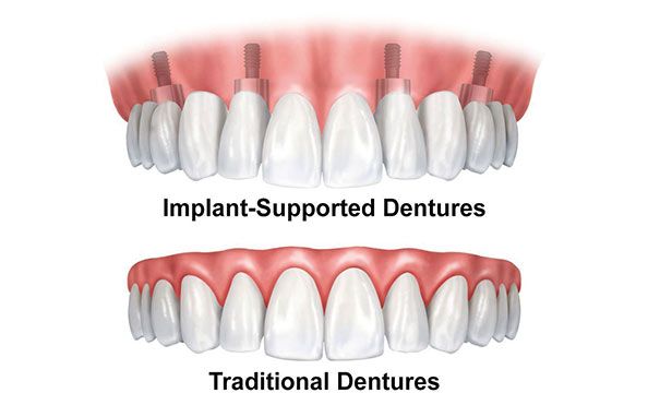 dentures-alternatives