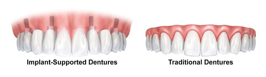 dentures-implant-supported-denture-benefits-2