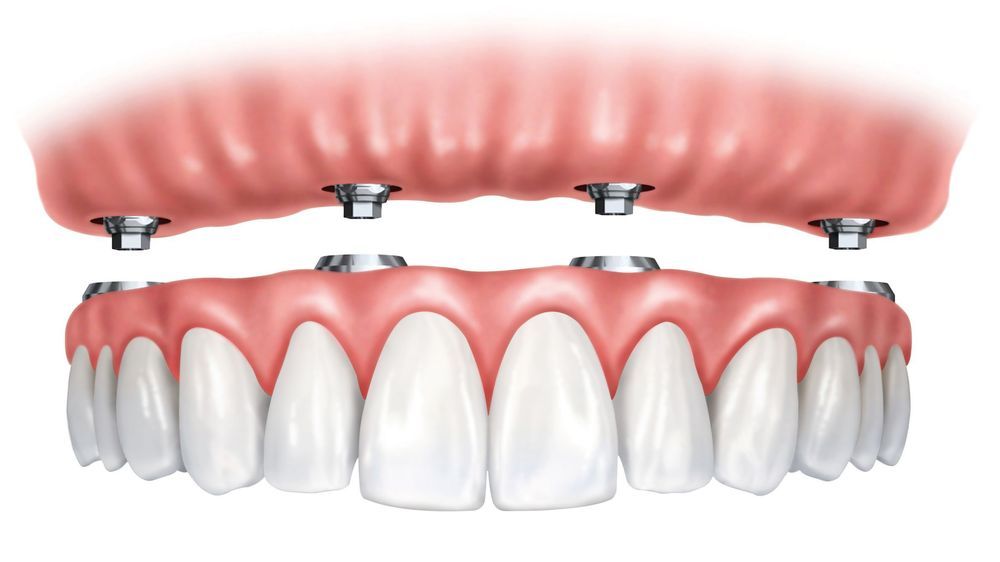 dentures-implant-supported-denture-cost