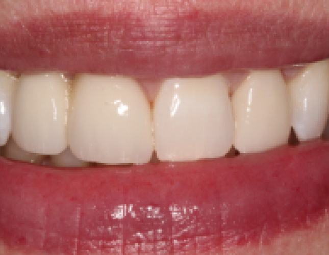 all-ceramic-bridge-and-veneer-2-after