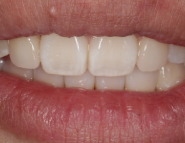 all-ceramic-veneers-3-after-1