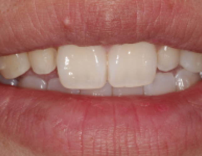 all-ceramic-veneers-3-before-1