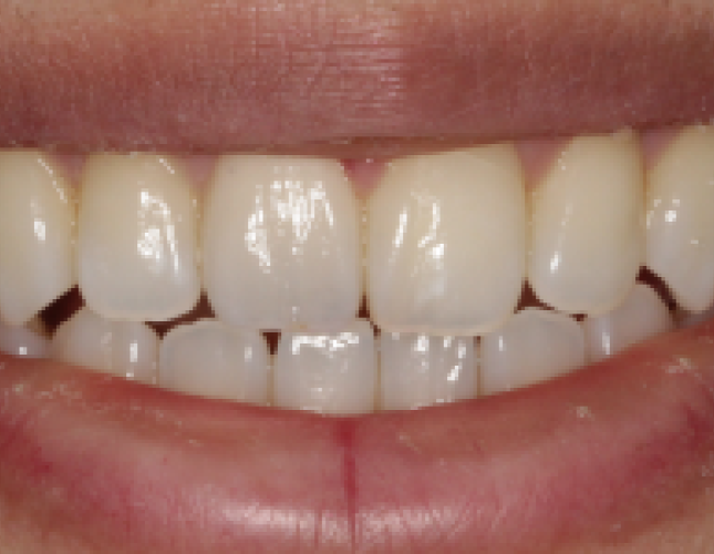 ceramic-crown-1-after