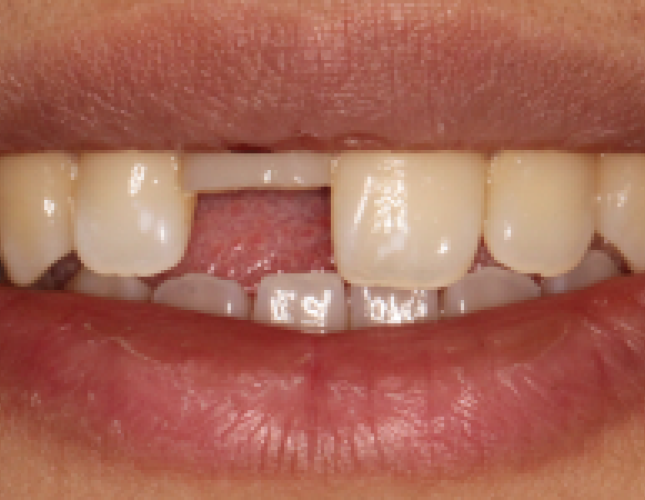 ceramic-crown-1-before