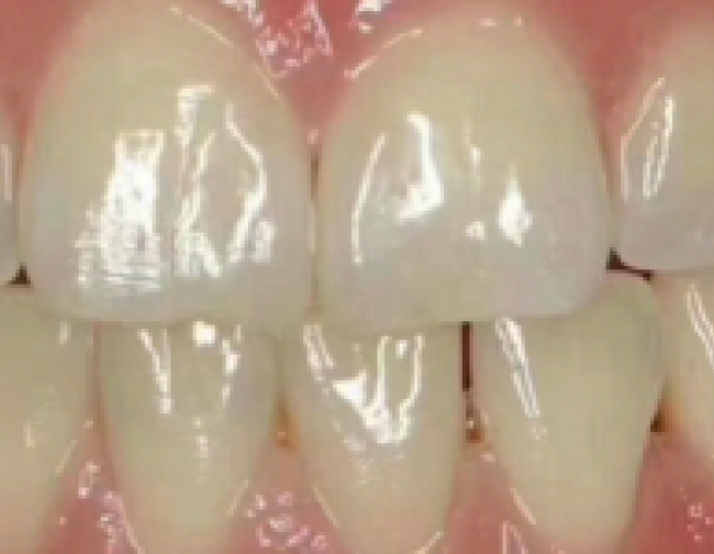 ceramic-veneer-1-after-1