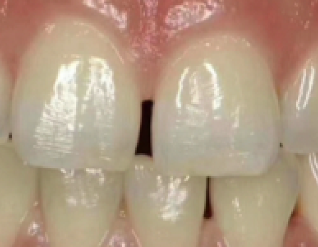 ceramic-veneer-1-before-1