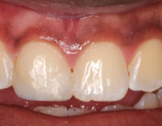composite-restoration-4-after-1
