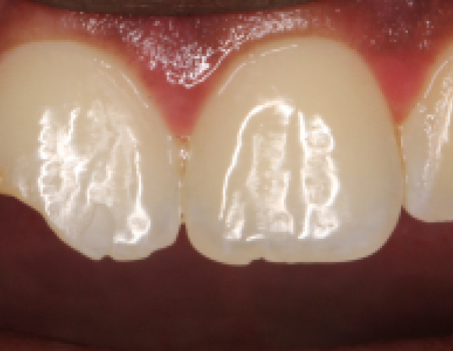 composite-restoration-4-before-1