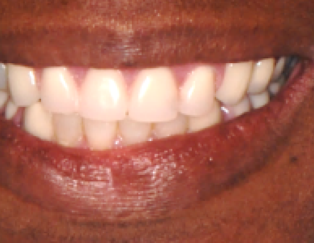 denture-1-after-1