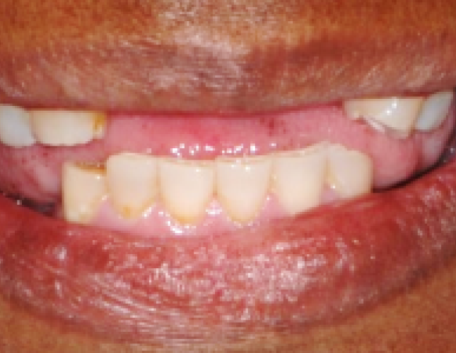 denture-1-before-1