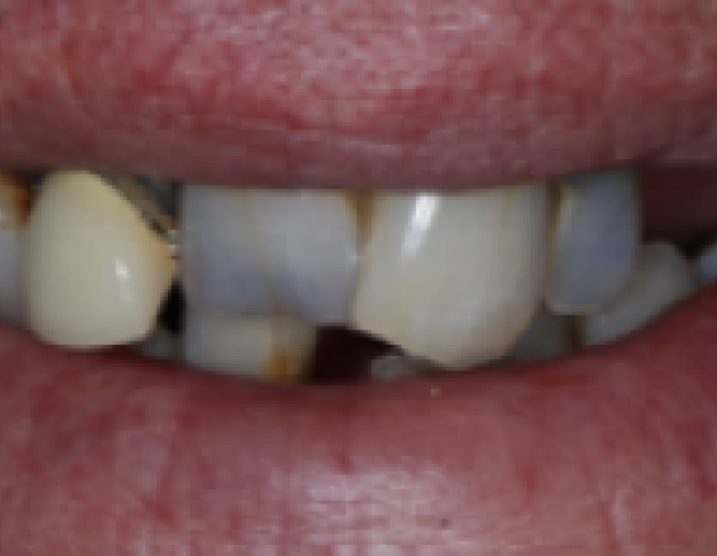 impant-1-before-1