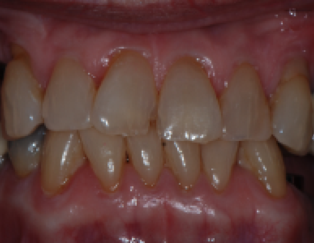impant-3-beofre-1
