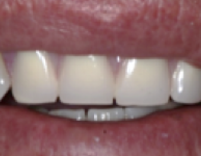 implant-1-after-1