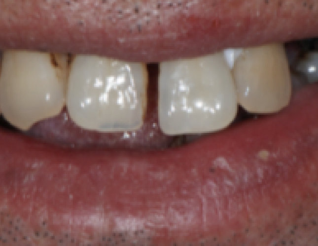 implant-2-before-1