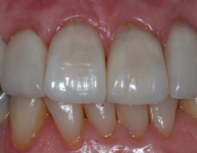 implant-3-after-1