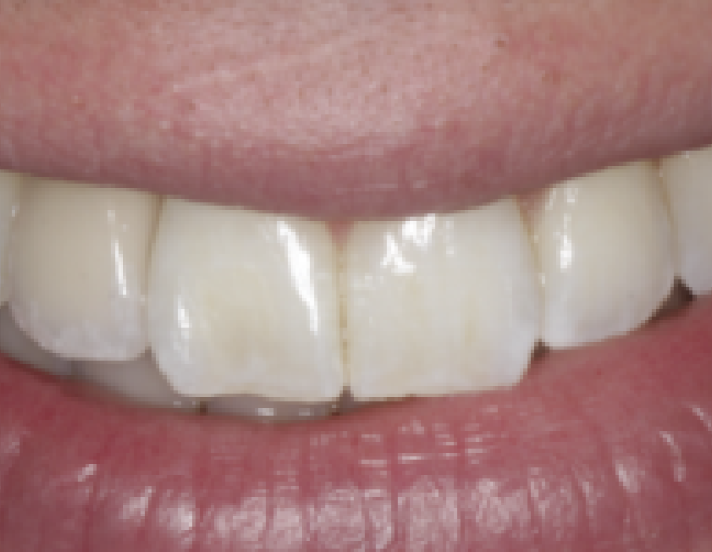 implant-5-after-1
