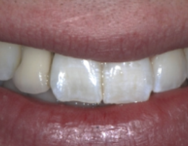 implant-5-before-1