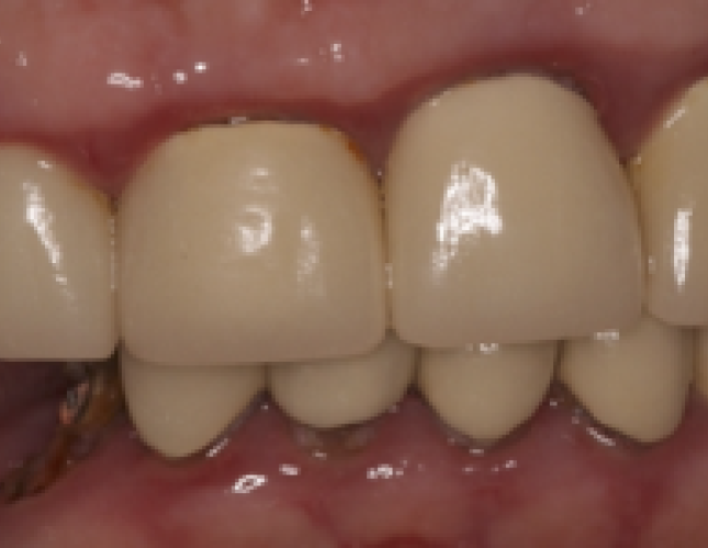 implant-6-before-1
