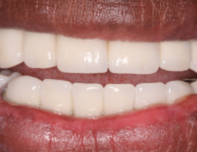 implant-7-after-1