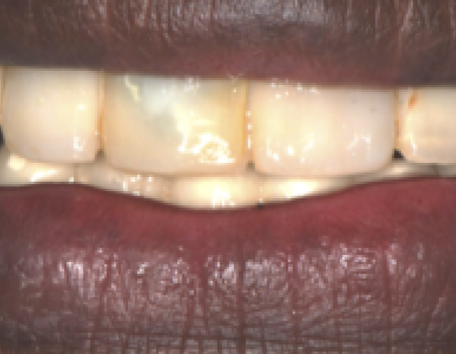 implant-7-before-1