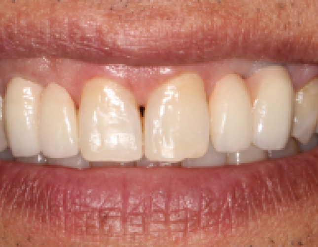 implant-after-4