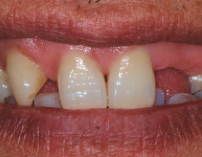 implant-before-4