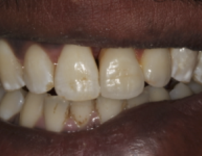 implant-supported-bridge-1-after