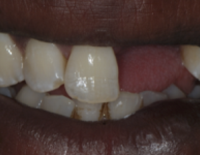 implant-supported-bridge-1-before