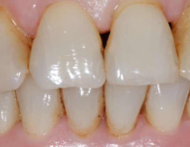 implant-supported-bridge-2-after