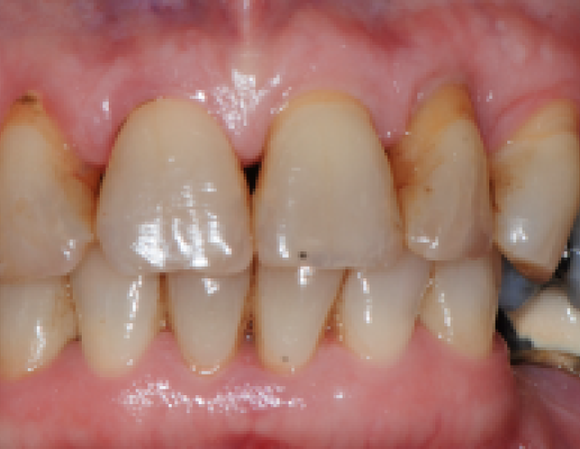 implant-supported-bridge-2-before
