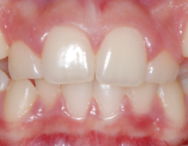 ortho-1-before-1