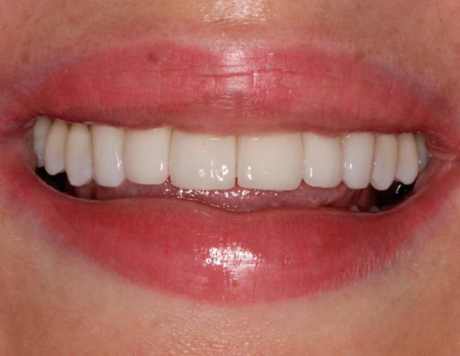 veneers-after