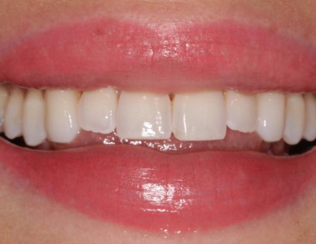 veneers-before