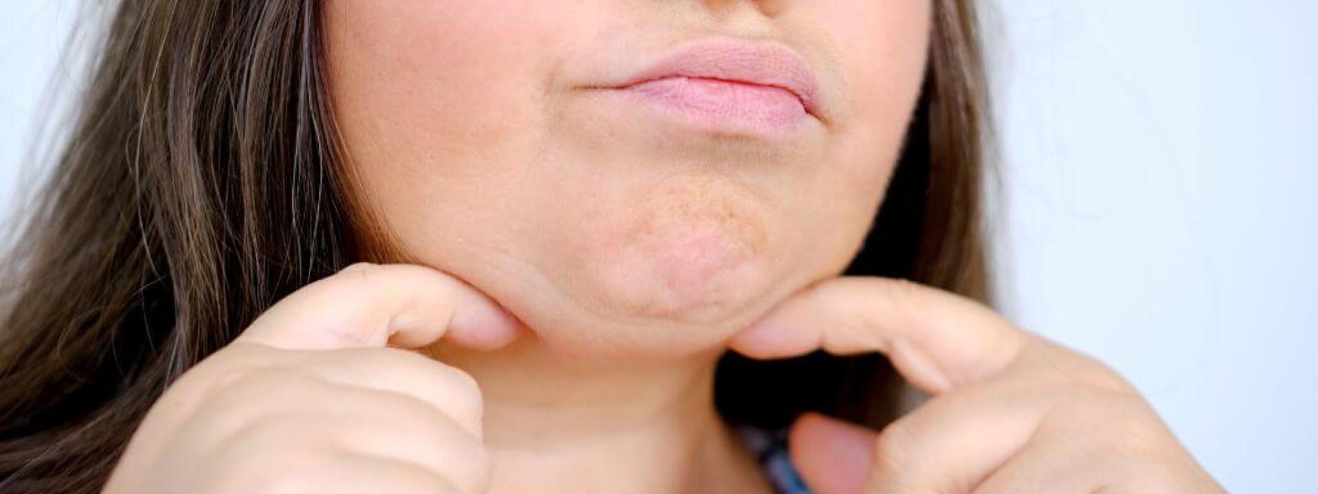 Middle aged woman's baggy chin ptosis.